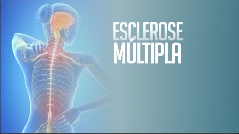 7 Fatos sobre Esclerose Múltipla que você precisa saber