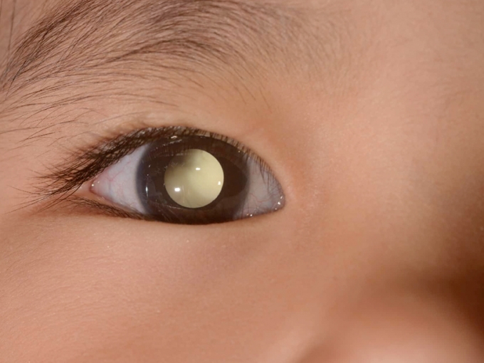 Retinoblastoma: diagnóstico precoce do tumor ocular infantil garante índices elevados de cura