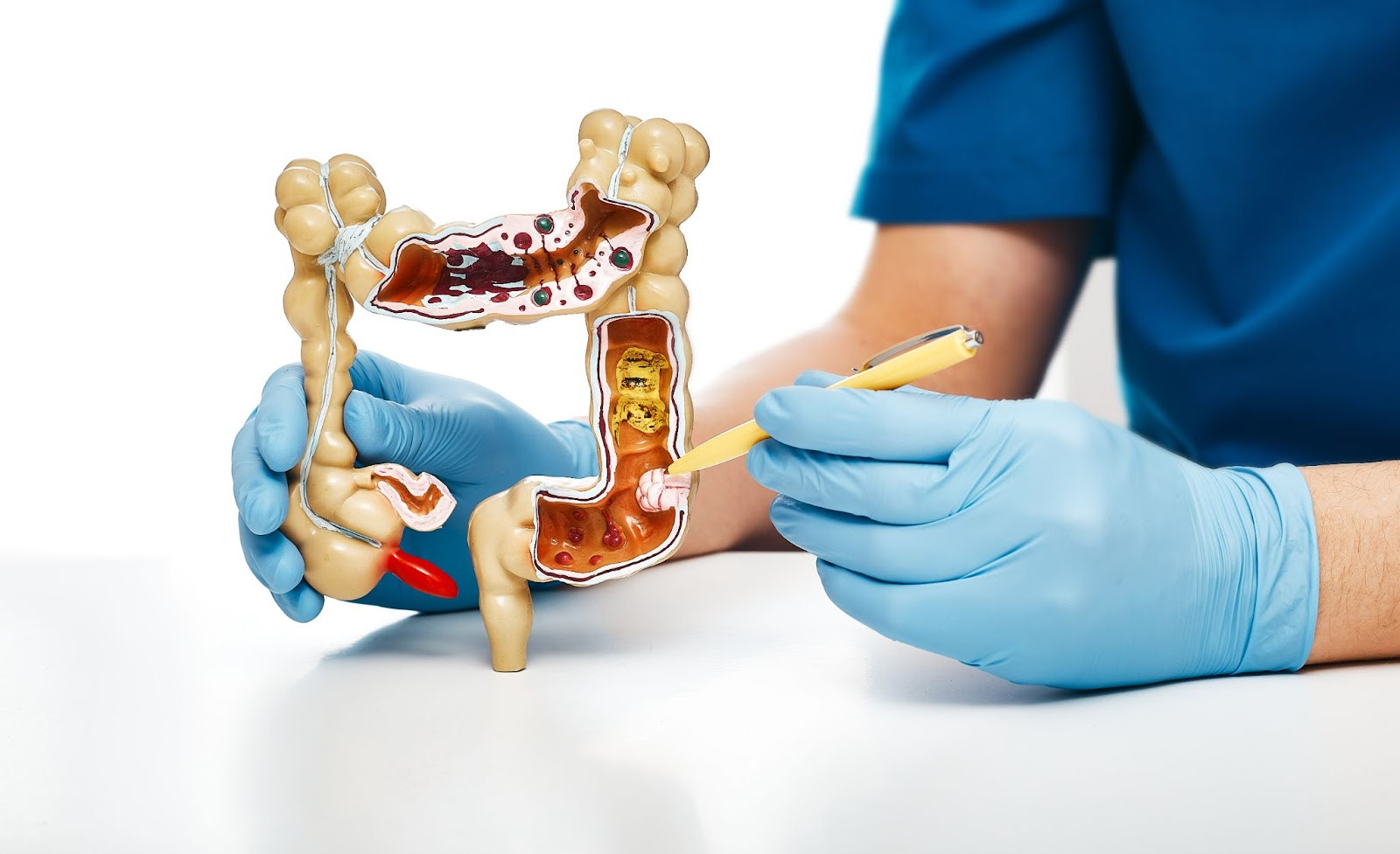 Casos de câncer de intestino podem ser evitados com exames de rotina, alerta especialista