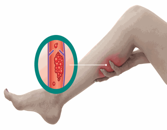 Principais sinais de trombose e como se proteger da doença 