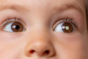 Retinoblastoma infantil: reflexo esbranquiçado nos olhos pode representar tumor raro