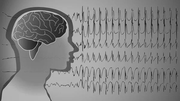 Pacientes com epilepsia ganham esperança com tratamento avançado de Estimulação Cerebral Profunda (DBS)