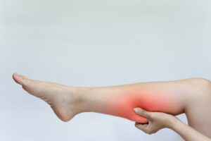 Insuficiência Venosa Crônica afeta milhões de brasileiros e pode evoluir para quadros irreversíveis