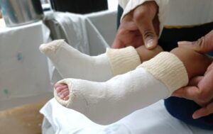 Tratamento na infância de pé torto garante correção e evita dificuldades na fase adulta
