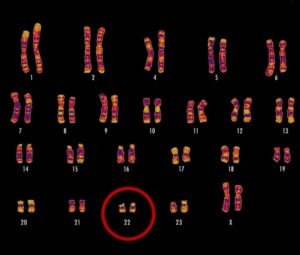 Diagnóstico genético amplia chances de tratamento precoce e melhor qualidade de vida em casos de Síndrome de DiGeorge