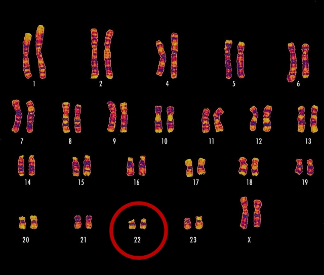 Diagnóstico genético amplia chances de tratamento precoce e melhor qualidade de vida em casos de Síndrome de DiGeorge
