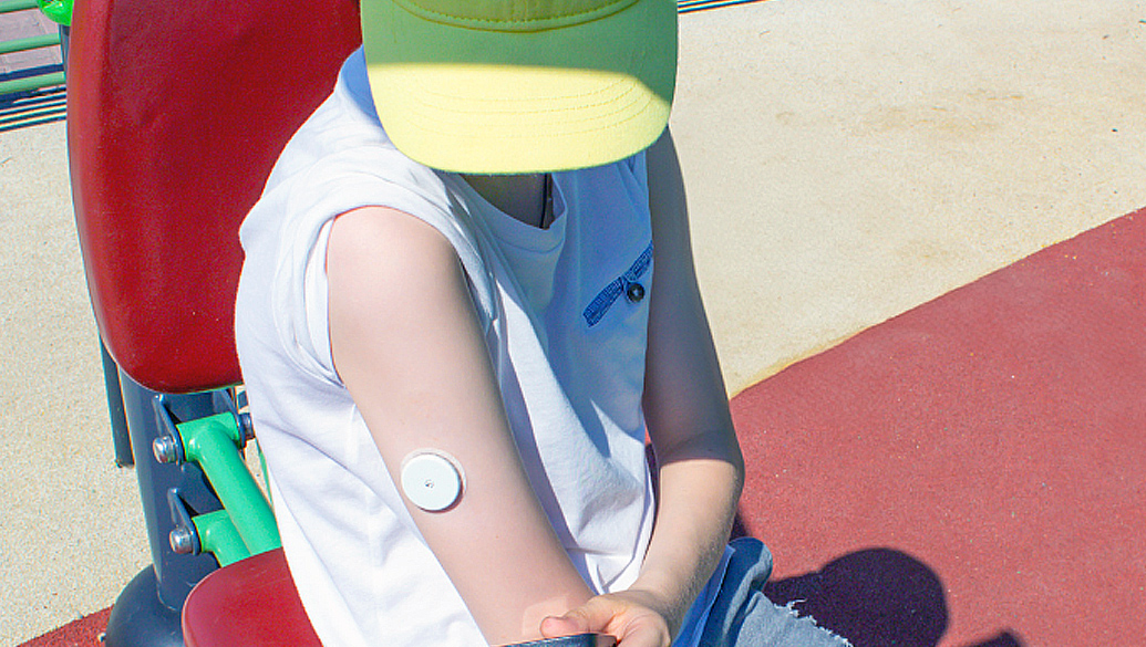 Estudos alertam sobre problemas de pele em crianças e adolescentes que utilizam dispositivos para controlar diabetes