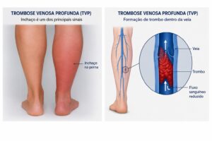 Nova lei amplia a prevenção da trombose e fortalece a segurança hospitalar