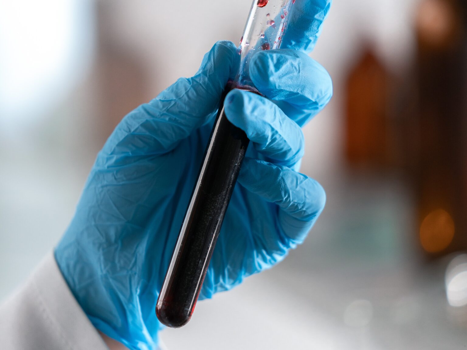 Colesterol alto pode avançar sem sintomas e elevar risco de infarto e AVC