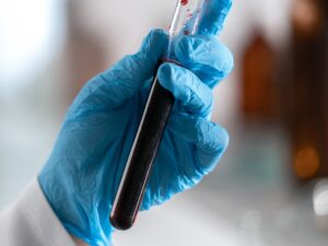 Colesterol alto pode avançar sem sintomas e elevar risco de infarto e AVC